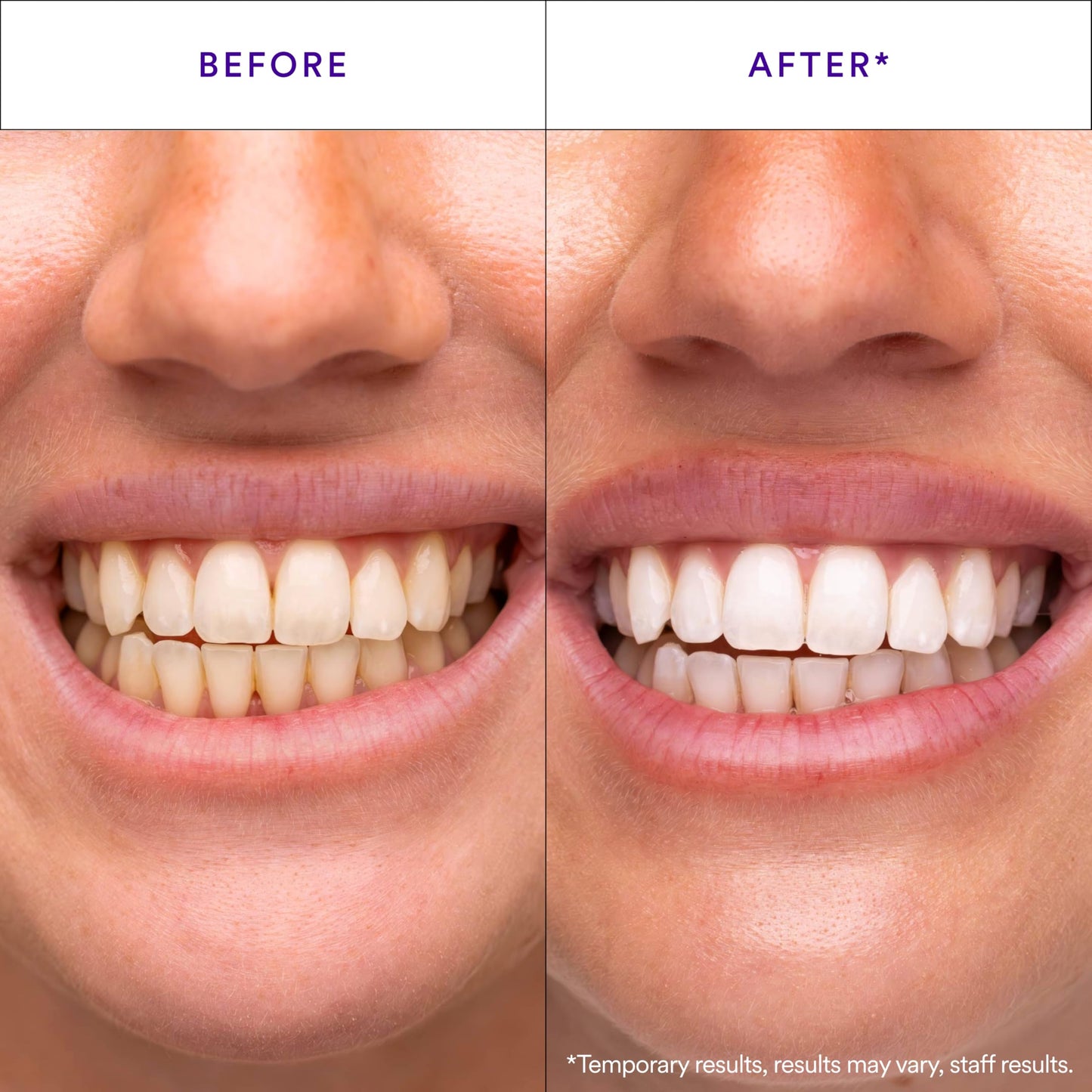 V34Purple Teeth Whitening Strips – Colour Correcting Stain Care