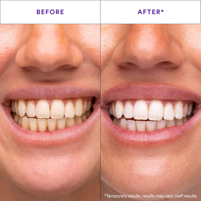 V34Purple Teeth Whitening Strips – Colour Correcting Stain Care