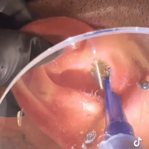 Home Ear Cleaning Tool — Manual Push-Button Design